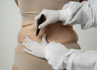 การดูดไขมัน (Liposuction) คืออะไร พร้อมข้อควรรู้ก่อนตัดสินใจ